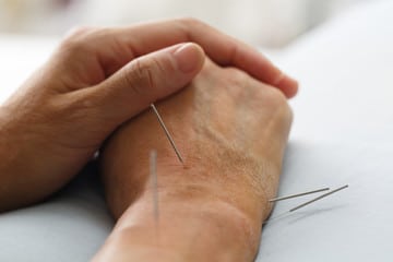 accupuncture